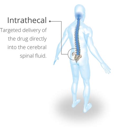 Intrathecal Injection