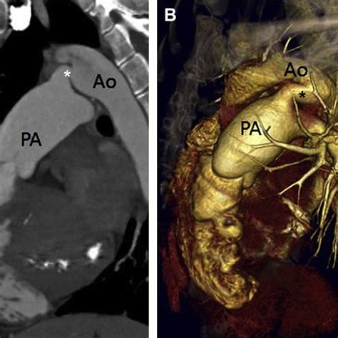 Dextro-transposition of the great arteries. (A) Axial CT image shows ...