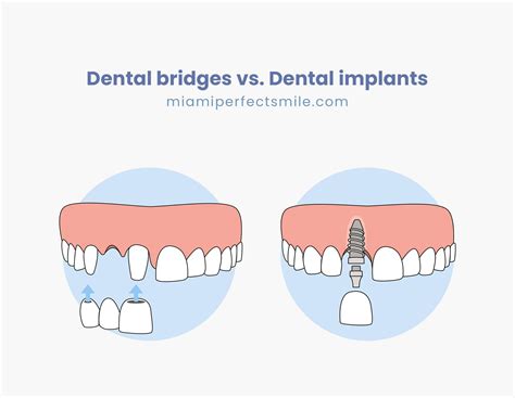 Dental bridges vs. Dental implants (with 2 comparative tables)