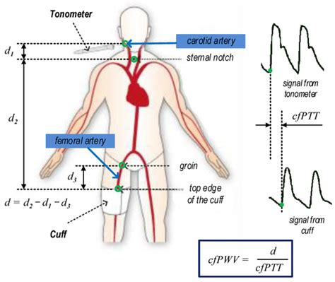 Sensors | Free Full-Text | Relationship between the Central and Regional Pulse Wave Velocity in ...