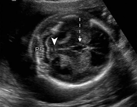 Fetal Brain Anomalies Ultrasound