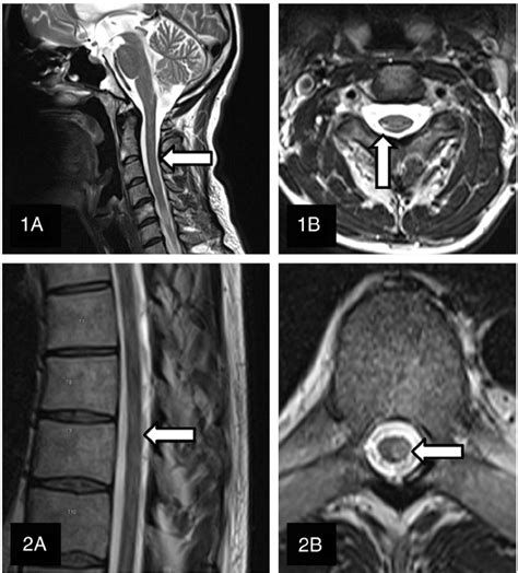 Cervical Spine Ms Lesions On Mri