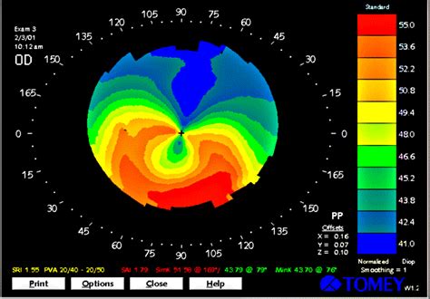 Keratoconus Topography | Optometry :) UHCO student 2018 | Pinterest