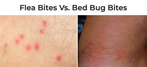 Flea Bite Dust Mite Bed Bug Bite – Rach Ellisa