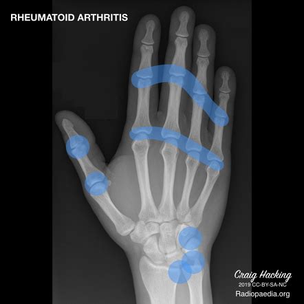 Rheumatoid arthritis | Radiology Reference Article | Radiopaedia.org