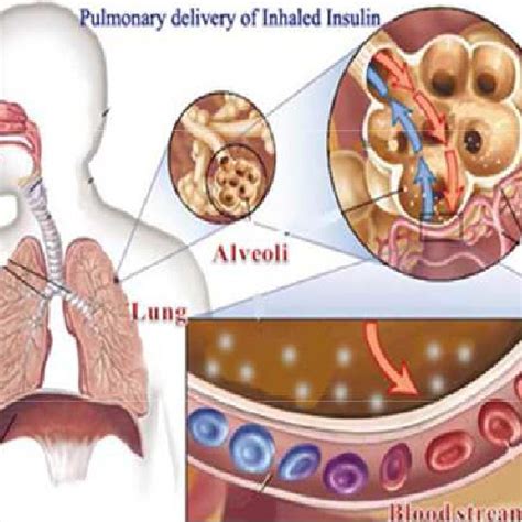 (PDF) Advantages of inhaled insulin over insulin injection