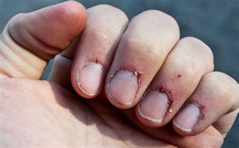 Infected Cuticles: Symptoms, Causes & Treatments – NailDesignCode