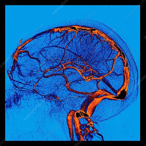 Enhanced Normal Lateral Cerebral Angiogram - Stock Image - C043/5538 ...