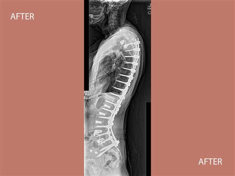 Adult Scoliosis Before & After - Orange, CA