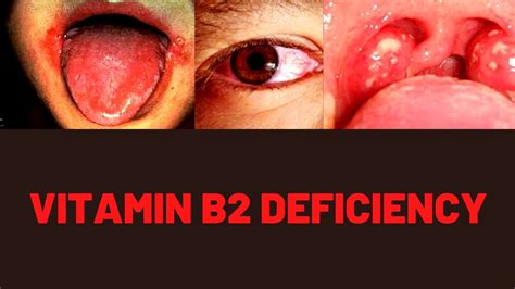 VITAMIN B2 BENEFITS, FOOD SOURCES, DEFICIENCY SYMPTOMS - YouTube