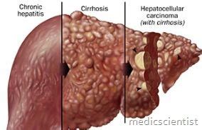 Alcoholic Liver Disease Diagnosis CAGE criteria and Treatment | MedicScientist :: Total Health ...