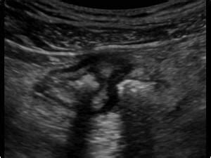 1.6.1 Diverticulosis and diverticulitis | Ultrasound Cases in 2020 | Diverticulitis ...