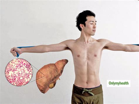 Can You Be Skinny And Have Fatty Liver Disease? | OnlyMyHealth