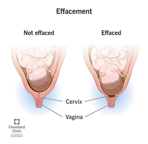 Cervix Dilation Chart: Signs, Stages And Procedure To Check, 44% OFF