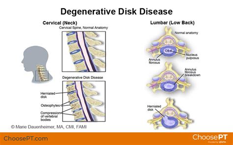 Degenerative Disc In Thoracic Spine