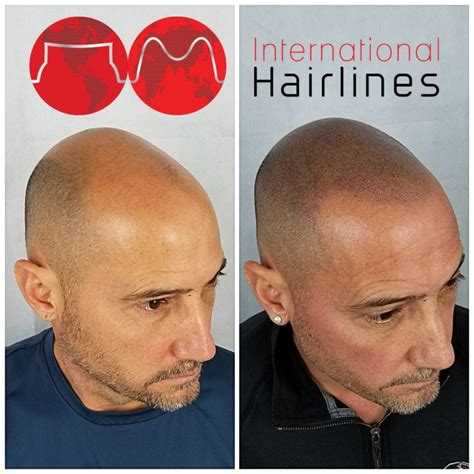 Scalp Micropigmentation Aftercare Guidelines - International Hairlines