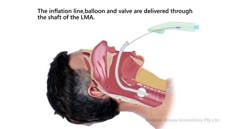 Lma Vs Endotracheal Intubation