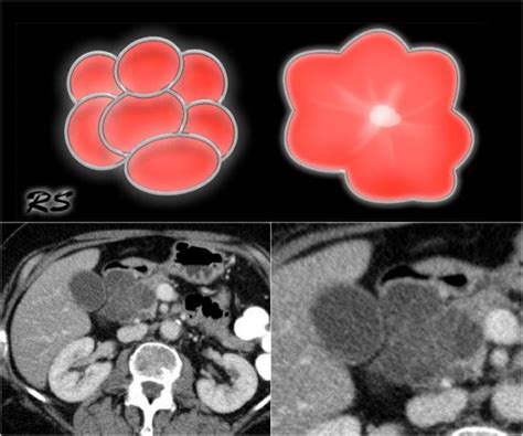 The Radiology Assistant : Pancreatic cystic Lesions