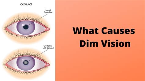 What Causes Dim Vision - YouTube