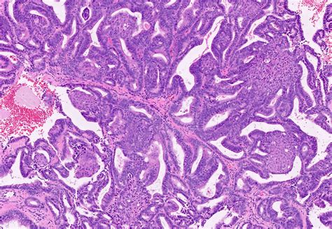 Papiloma Fibroepitelial Histologia Cancer Endometrial Prognosis | My XXX Hot Girl