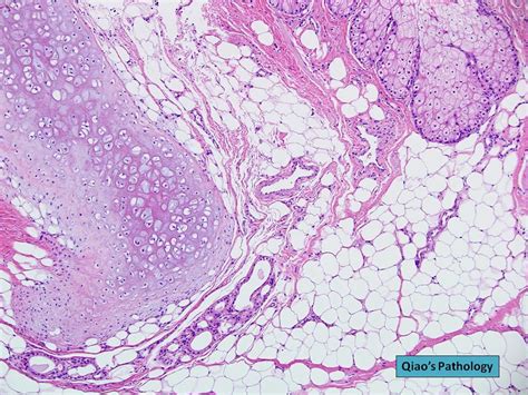 Qiao's Pathology: Ovarian Dermoid Cyst (Mature Cystic Tera… | Flickr