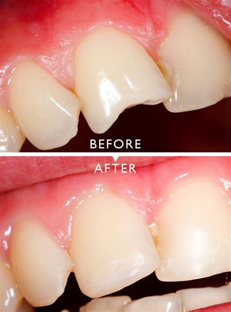 Cracked, Chipped, Broken Tooth Repair - Two Rivers Family Dentistry