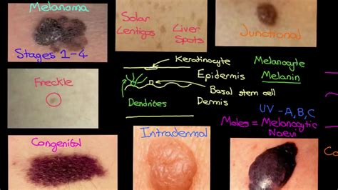 Melanocytic Lesions Part 3 - YouTube