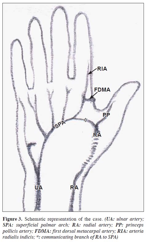 A unique variation of superficial palmar arch