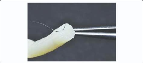 Avance Nerve Graft. | Download Scientific Diagram