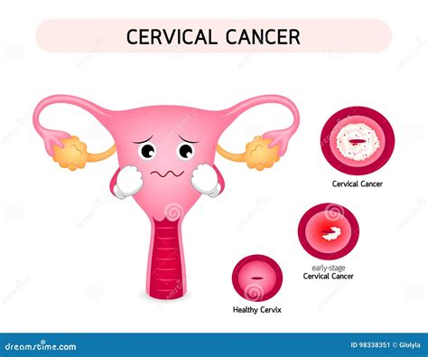 Cervical Cancer Diagram with Sadness Uterus Cartoon Character. Stock Vector - Illustration of ...