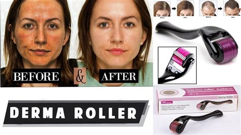 how to use derma roller || Hair Growth Wrinkles Review ||Before After Re... | Derma roller ...