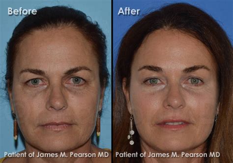 Browlift, Forehead Lift Photos - Before & After - Dr. James Pearson ...