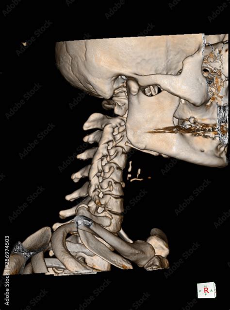 CT Scan cervical spine 3 D render and X-ray C-spine finding Reverse ...