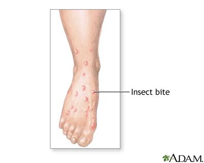 Insect bites and stings: MedlinePlus Medical Encyclopedia Image