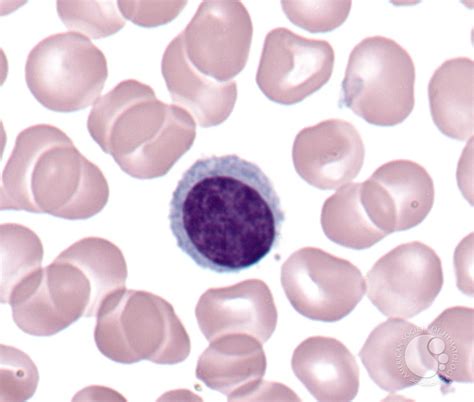 Plasmacytoid Lymphocyte - 1.