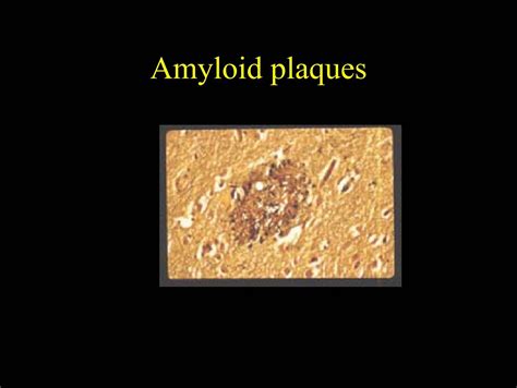 Amyloid plaques