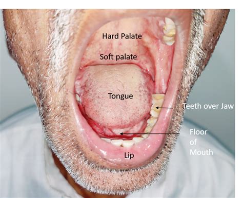 Oral Cancer Under Tongue