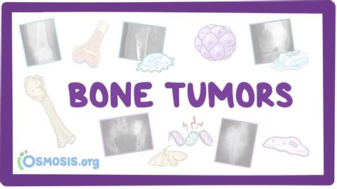 Which Is The Most Common Benign Tumor Of Bone? The 5 Detailed Answer - Ecurrencythailand.com