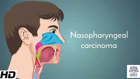 Nasopharyngeal carcinoma, Causes, Signs and Symptoms, Diagnosis and ...