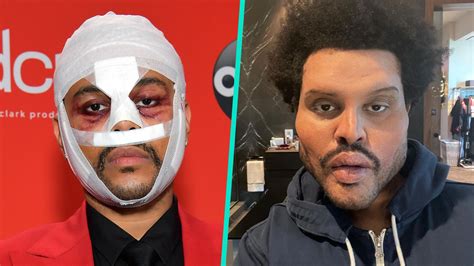 The Weeknd Finally Explains The Meaning Behind His Face Bandages ...