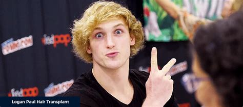 Logan Paul Hair Transplant - Smile Hair Clinic