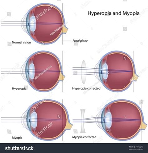 Common Eye Defects : Myopia And Hyperopia Stock Vector Illustration ...