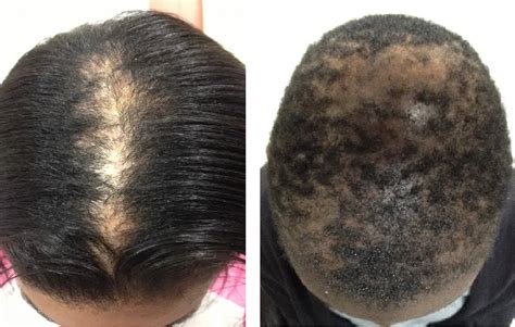 Scarring Alopecia: Causes, Stages & Treatment Options | Wimpole Clinic