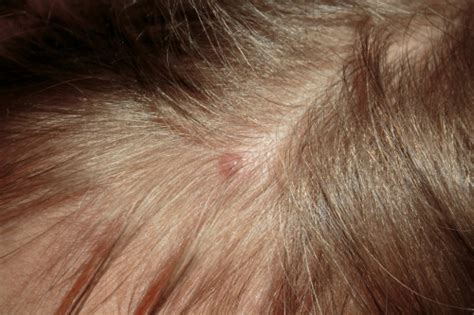 Effective Home Remedies to Treat Scalp Folliculitis