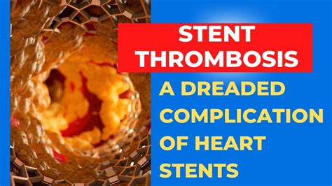 Stent Thrombosis: An important complication after heart stents. Part 1 ...