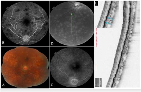 Visualisation of Dalén Fuchs nodules using various imaging modalities ...