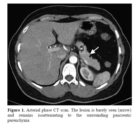 Successful Preoperative Localization of a Small Pancreatic Insulinoma ...