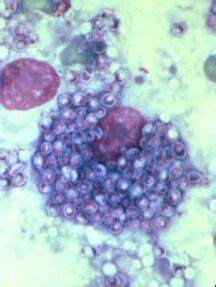 cyto46-histoplasmosis