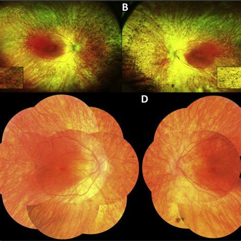 Optos ultra-widefield fundus photos of the right (A) and left (B) eyes ...