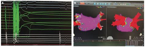 Pulsed Field Ablation for Atrial Fibrillation: Recent Advances and ...